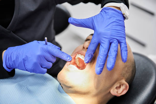 Best Emergency Wisdom Teeth Removal in St Martinville, LA